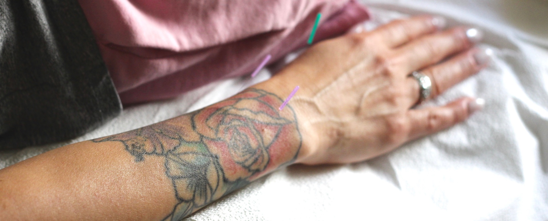 Acupuncture hand treatment